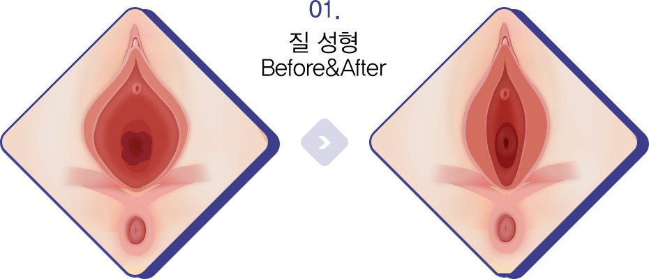 질 성형 Before&After