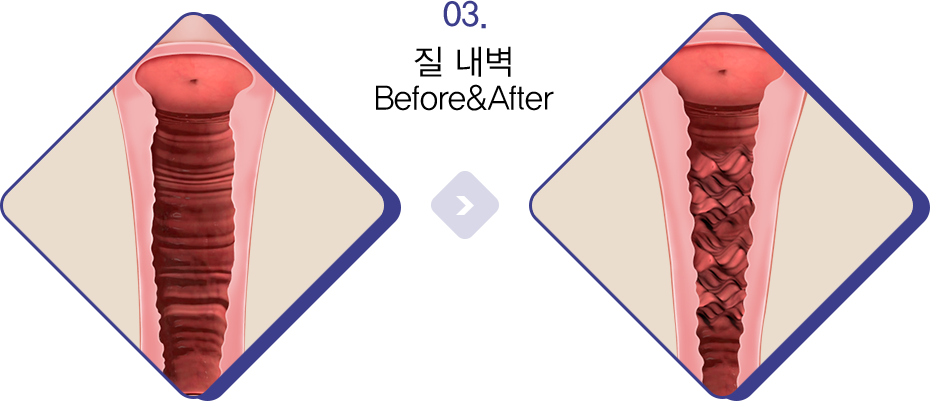 질 내벽 Before&After