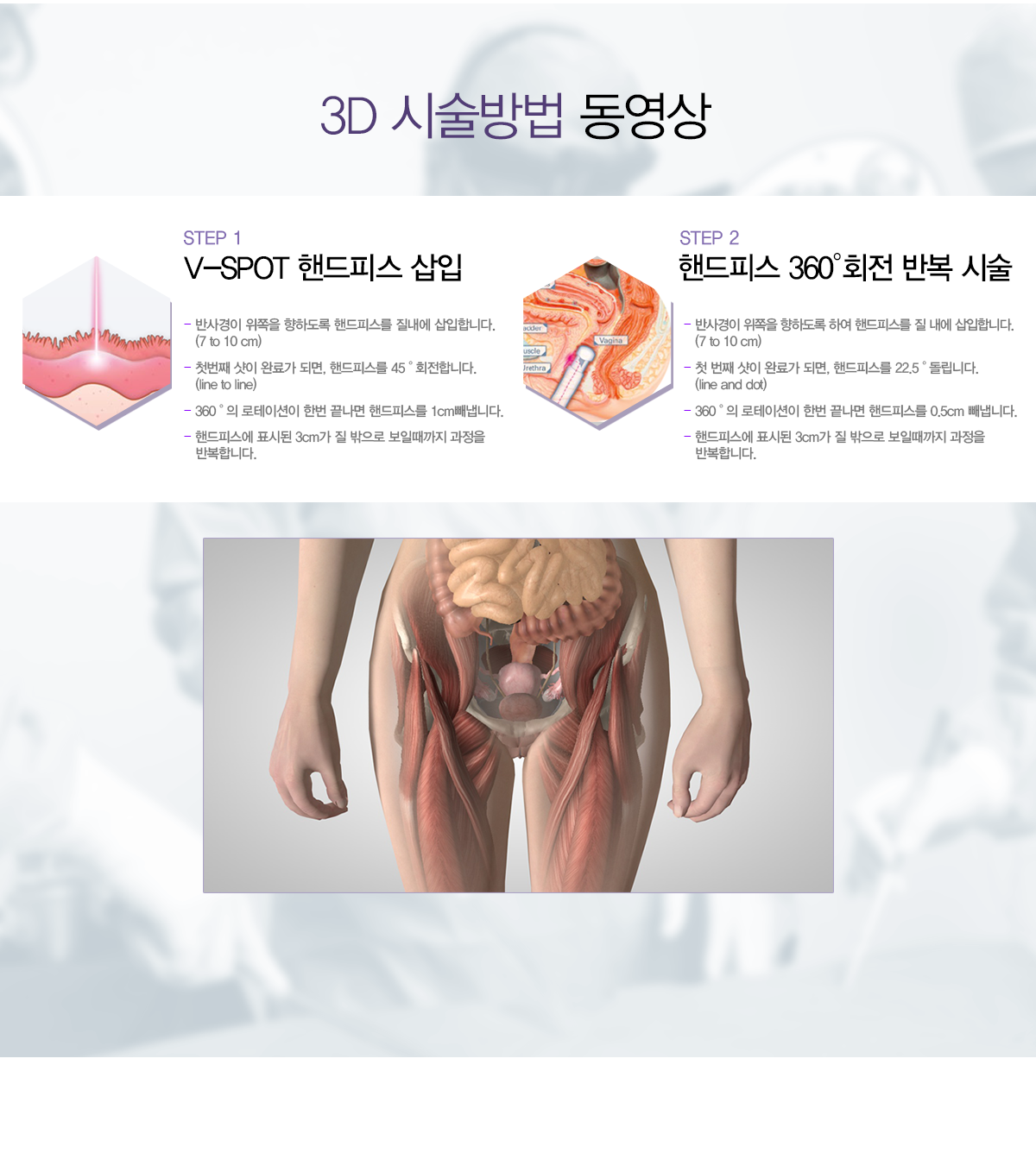 3D 시술방법 동영상