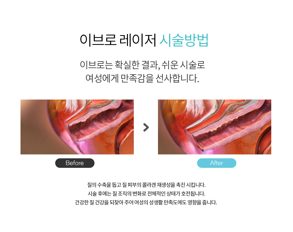 질성형수술,질축소,질축소수술가격,소음순늘어남,소음순수술,이쁜이수술후기