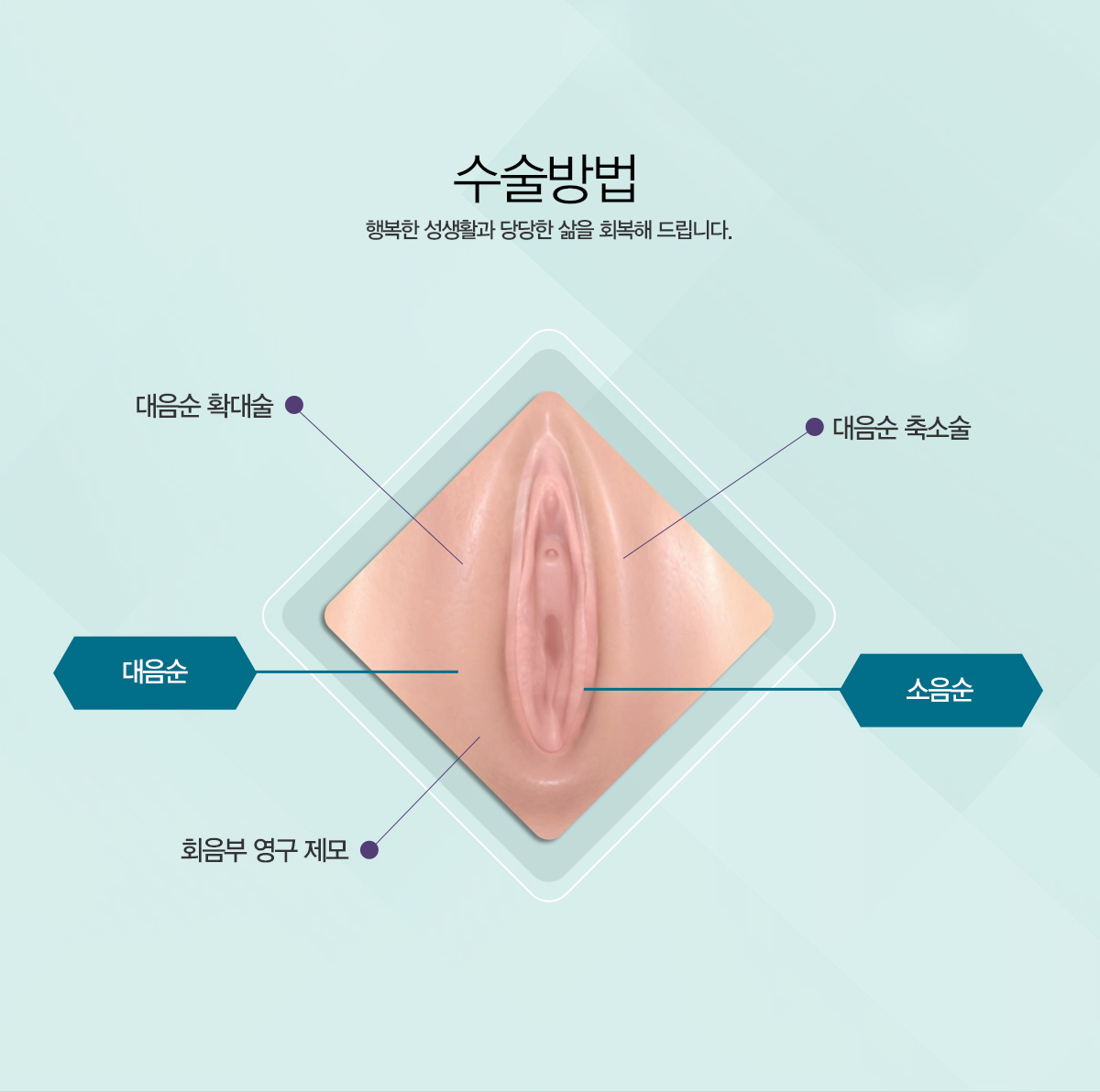 소음순늘어남