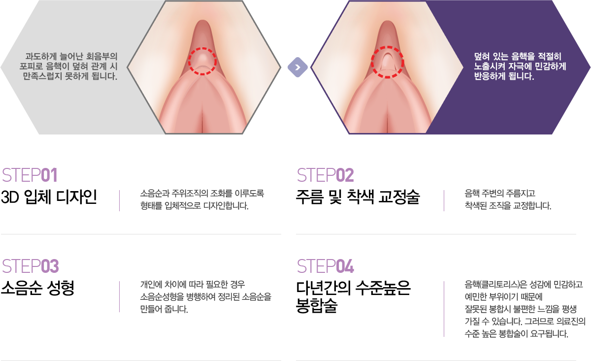 음핵성형,소음순수술잘하는곳,음핵수술비용,재수술