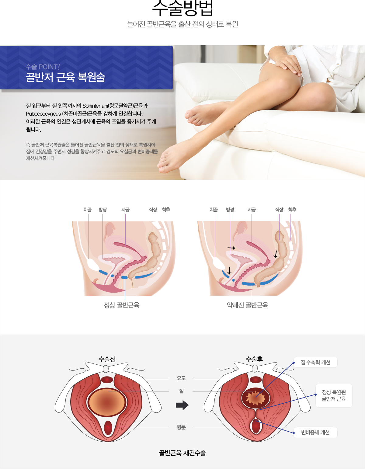 수술방법 늘어진 골반근육을 출산 전의 상태로 복원